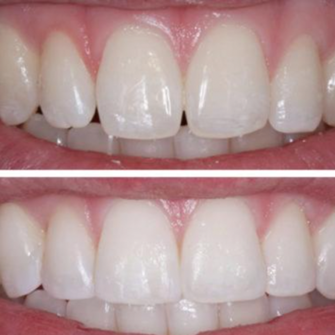 HiSmile Zahnreparatur-KIT – Schöne Zähne in nur wenigen Minuten! 