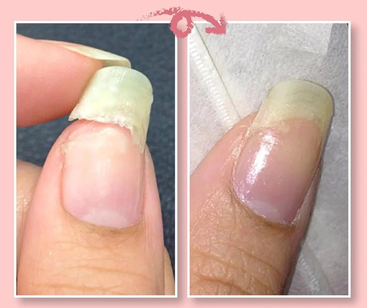 NailRepair™ – Sofortiges Nagelschutzgel 